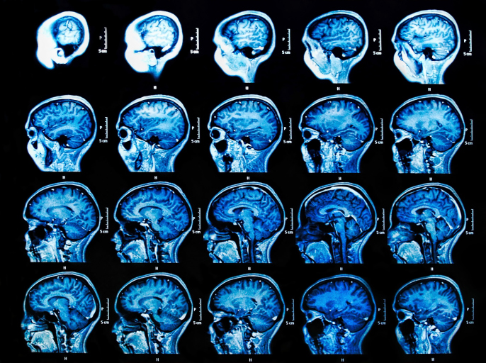Nuevas formas de detectar el Alzheimer - Las placas lo explican todo 
