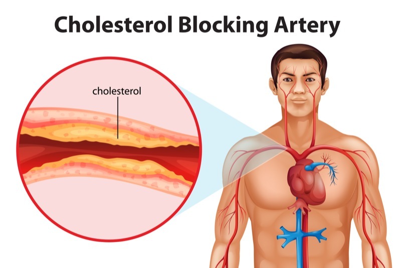 ¿Qué es el colesterol “bueno” y “malo”? - El malo