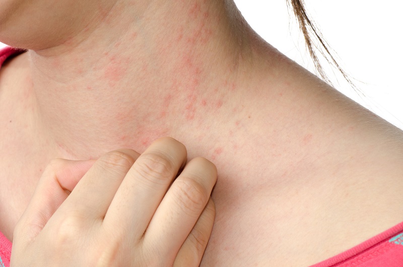 Avanzar Ritual Descortés Remedios naturales contra la dermatitis