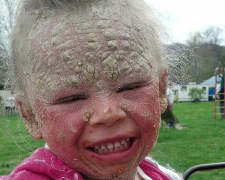 Problemas raros de la piel: fotos, causas  y tratamientos - La niña que no puede ver el sol