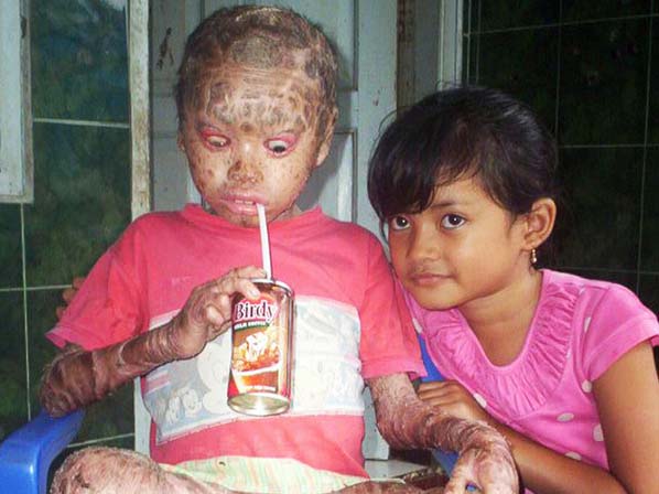 Problemas raros de la piel: fotos, causas  y tratamientos - El “niño cebra”