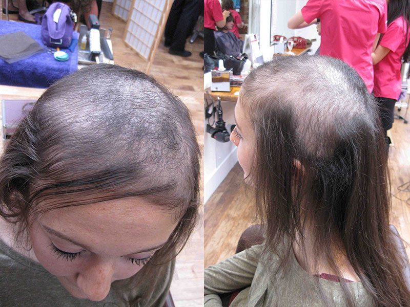 Una joven es adicta a arrancarse el pelo - En apuros