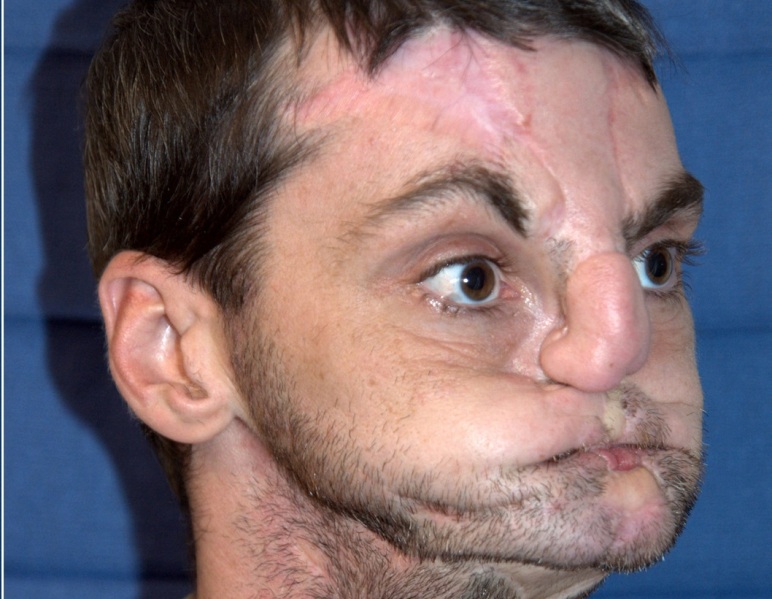 Cirugías extremas que cambiaron vidas - "Mi cara daba miedo"