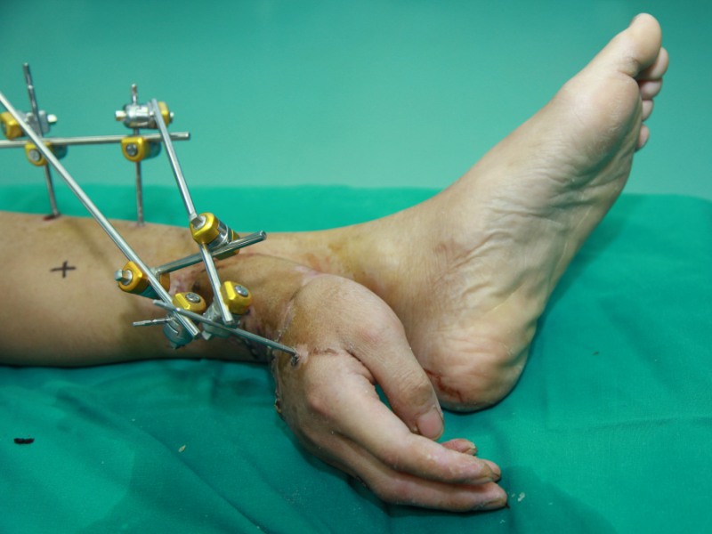 Cirugías extremas que cambiaron vidas - "Plantar" la mano en el pie