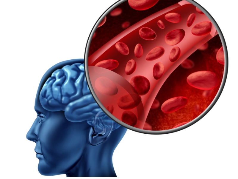 ¿Qué es la hemofilia? Síntomas y tratamiento - Sangrado en el cerebro 