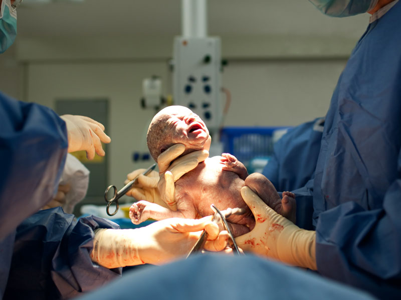 Just Say No To These 10 Delivery Room Practices - 4. A C-Section for a Low-Risk Birth