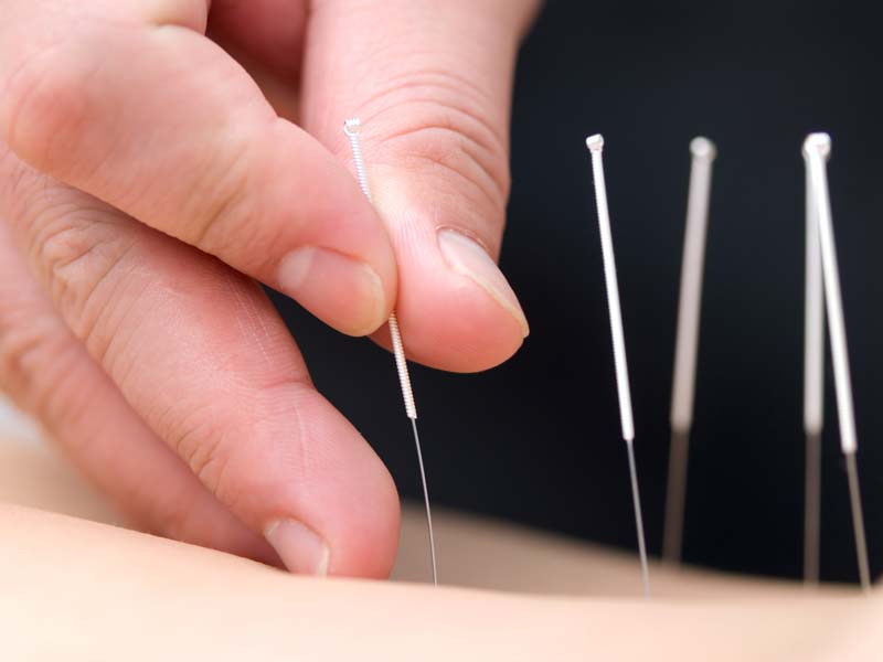 Hemofilia y remedios naturales: cuidado - El uso de la acupuntura