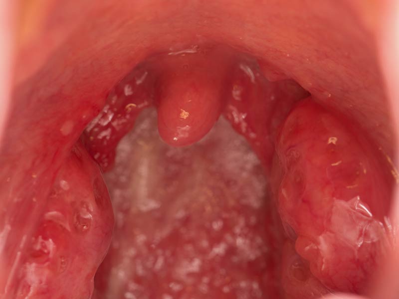 Dolor de garganta ¿resfrío o infección? - Amigdalitis estreptocócica