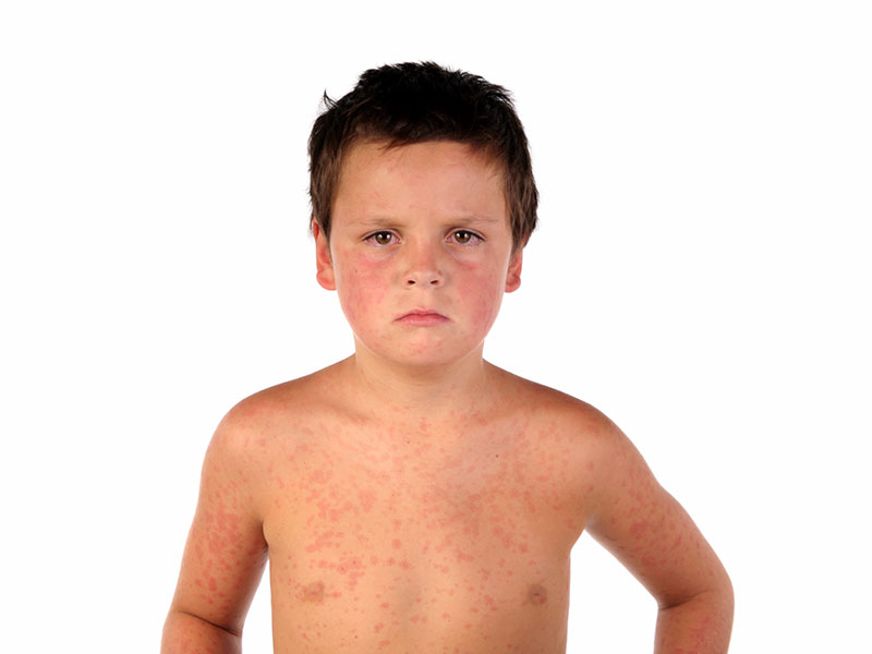 Qué es y cómo se trata el sarampión - ¿Es peligroso?