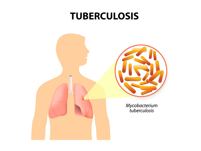 10 males que son 100% evitables con vacunas - 9. Tuberculosis