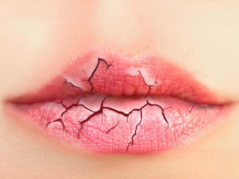 ¿Qué vitamina te falta? Señales que te lo dirán - #2 Labios con grietas	
