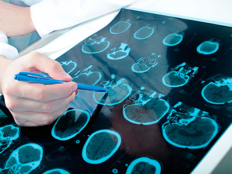 Las infecciones cerebrales más peligrosas - ¿Qué hacer?