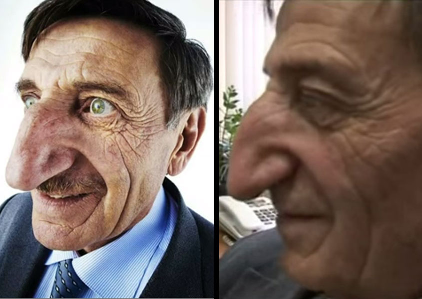 Los cuerpos más raros del mundo - La nariz más larga