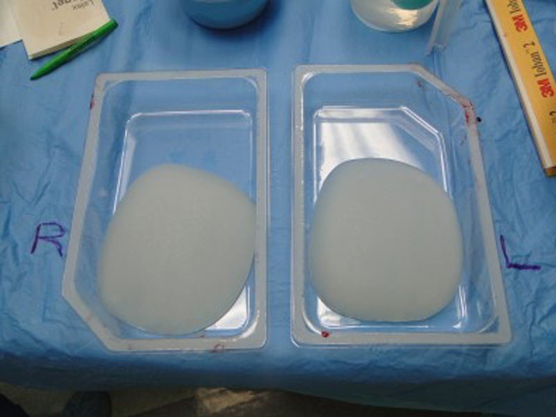 Jorge Kahwagi: ¿cuánto cuesta un implante de pectorales? - ¿En qué consiste?