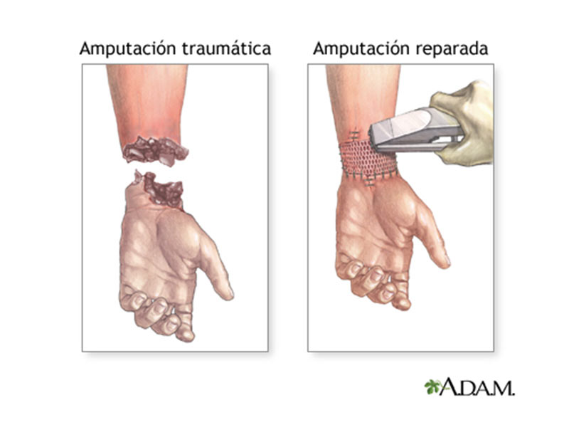 Reimplantan ambas manos a hombre tras sufrir accidente - ¿En qué consiste esta cirugía?