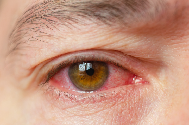 ¿Qué dice el color de los ojos sobre la salud? - Ojos rojos