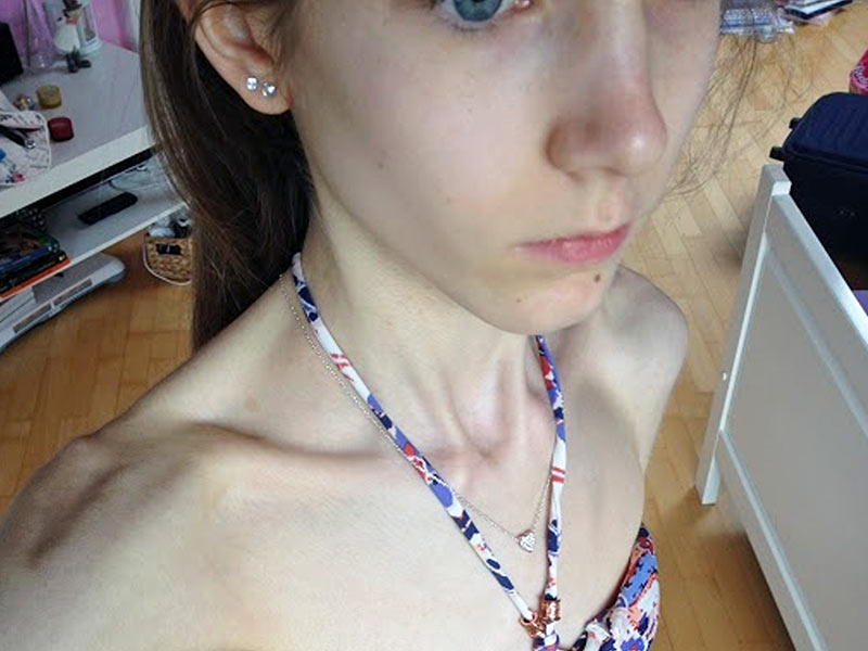 Así se ve una persona con anorexia - ¿Cómo identificar a alguien así?