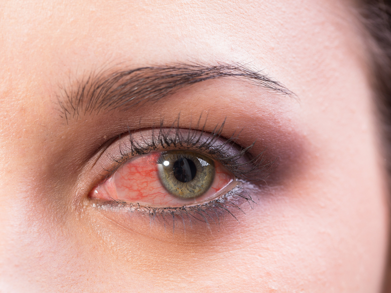 7 cosas sorprendentes que dicen los ojos sobre tu salud - 3. Ojos rojos: varias causas