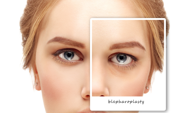 10 métodos para quitar las bolsas de los ojos - 10. Cirugía