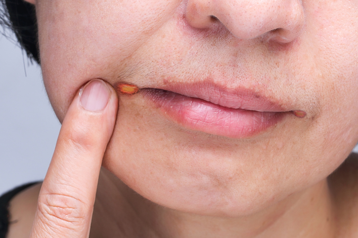 Tus labios pueden revelar enfermedades - Irritación en la comisura