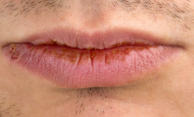 Tus labios pueden revelar enfermedades - Agrietados y rotos