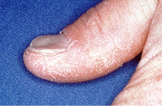 10 cambios en las uñas que pueden revelar una enfermedad - 9. Uñas en forma de cuchara