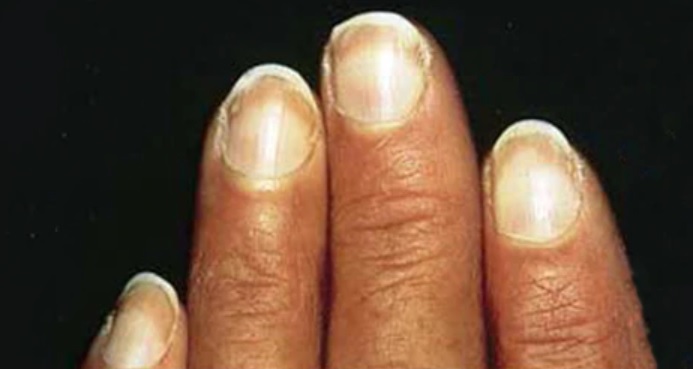 10 cambios en las uñas que pueden revelar una enfermedad - 10. Uñas de Terry o blancas