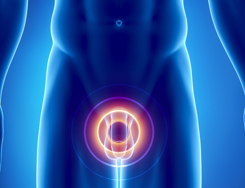 8 problemas de salud que pueden causar dolor de testículos - 6. Hidrocele