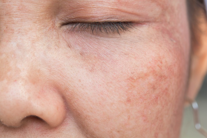 10 problemas de la piel en verano y cómo prevenirlos - 8. Alergia al sol