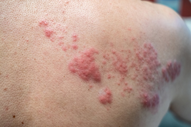10 problemas de la piel en verano y cómo prevenirlos - 6. Erupción por calor 