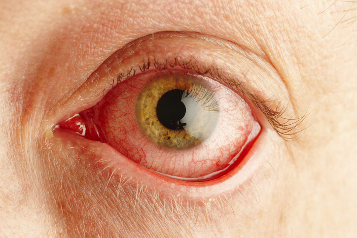 Cuáles son las principales causas de la visión borrosa - Otras afecciones oculares