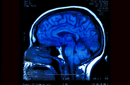 Qu Es La Muerte Cerebral Cerebro Y Sistema Nervioso Holadoctor Com