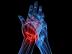 ¿En qué partes del cuerpo se presenta la artritis reumatoide?
