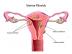  10: ¿Endometriosis o fibromas?