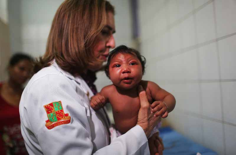 Virus del Zika y bebés con microcefalia: lo que debes saber - Qué es la microcefalia