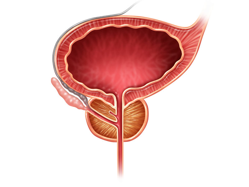 10 señales de alerta del cáncer de próstata - Cáncer de próstata