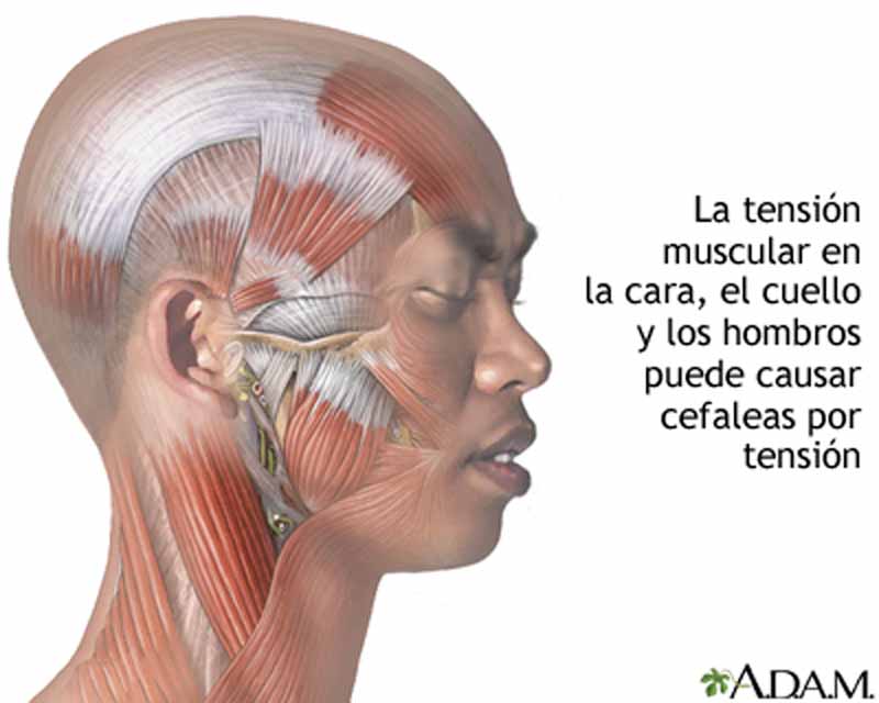 ¿Qué es la cefalea tensional y cómo se trata? - ¿Qué causa estas cefaleas?