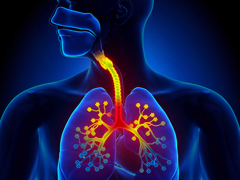¿Tos intensa?, podría ser bronquitis - ¿Qué es la bronquitis?