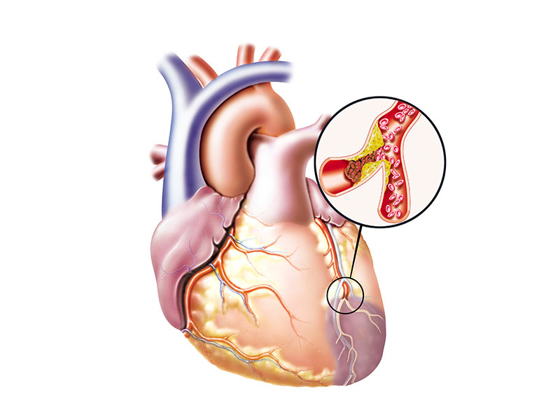 Señales de alerta de un ataque cardíaco - ¿En qué consiste un ataque cardiaco?