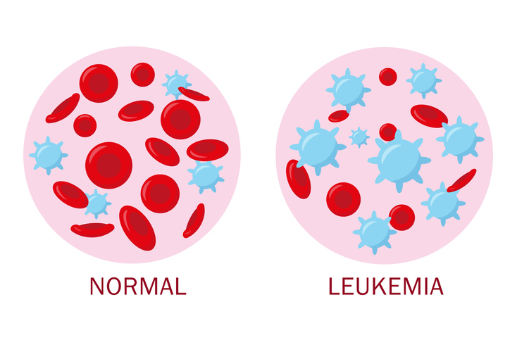Qué es la leucemia, cuáles son sus síntomas y cómo se trata - 
