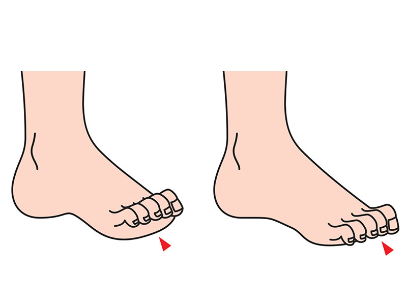 10 remedios naturales para problemas comunes de los pies  - 2. Para el dedo de martillo
