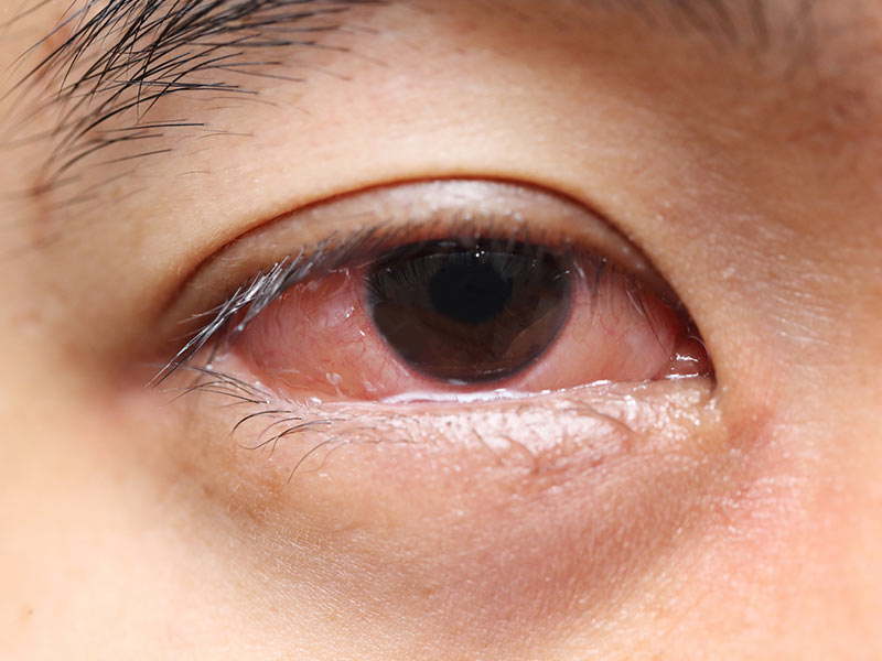5 razones para dormir sin lentes de contacto - Queratitis bacteriana 