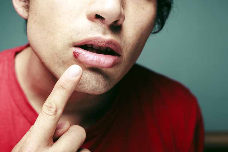 10 cosas que debes saber si tienes herpes - ¿Por qué tengo llagas tan seguido?
