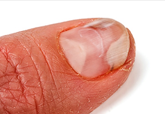 10 cambios en las uñas que pueden revelar una enfermedad - 3. Levantamiento de la uña