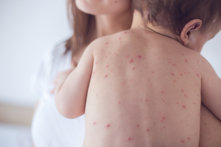 Cómo resguardar a tus hijos  de un brote de sarampión - Complicaciones