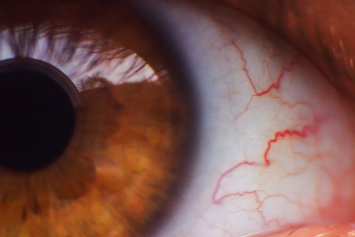  ¿Cuáles son los síntomas de un glaucoma? - Factores de riesgo