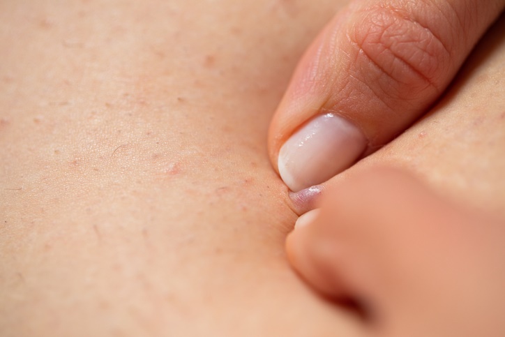 10 problemas de la piel en verano y cómo prevenirlos - 3. Foliculitis 