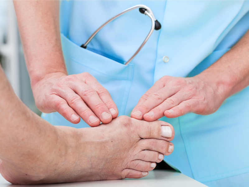 Artritis, lesiones y otros daños de los tacones altos - 3. Juanetes y dedos martillo