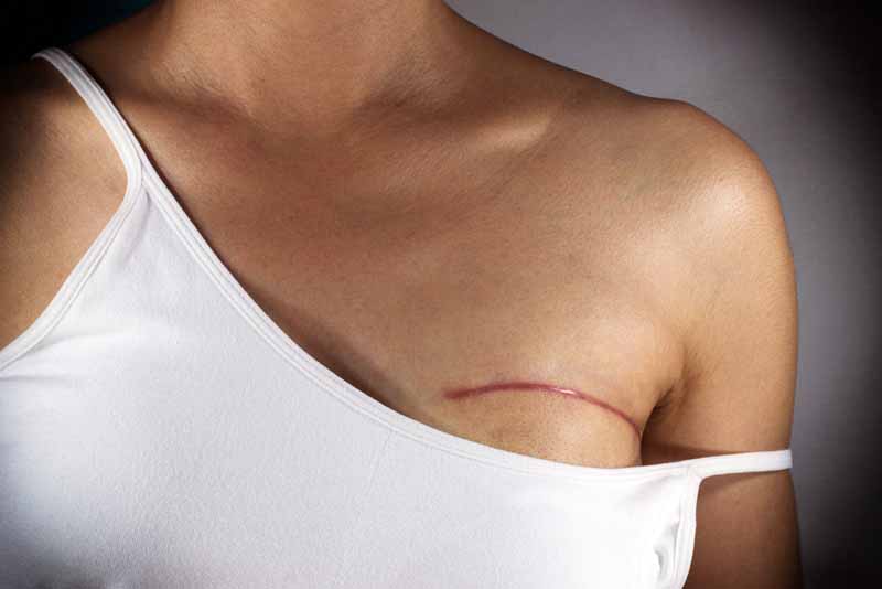 10 mitos acerca del cáncer de seno - Mito 4: Si me hago una mastectomía, no tendré otra vez cáncer de seno
