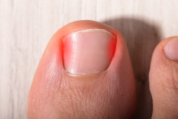 10 cambios en las uñas que pueden revelar una enfermedad - 4. Enrojecimiento e hinchazón alrededor de una uña